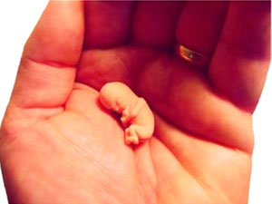 What Is Chemical Abortion Aid0181 What Is Chemical Abortion Aid0181