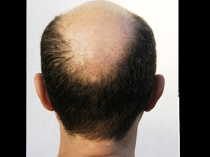 How to Prevent Balding Hair...!
