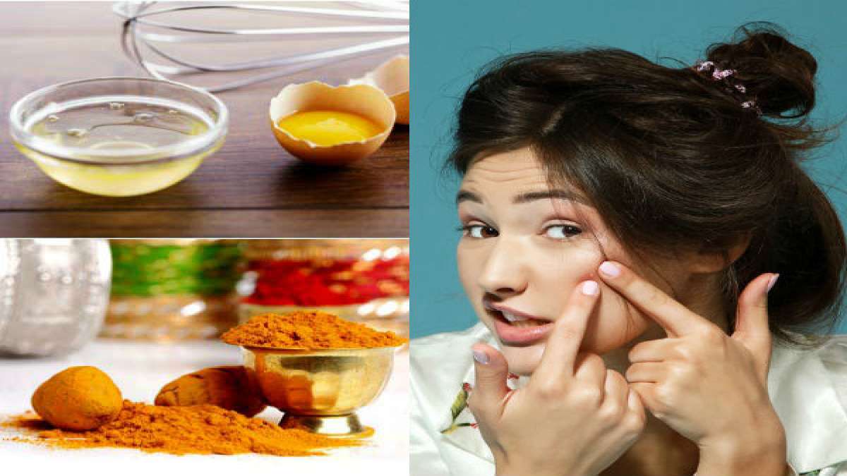 డూ ఇట్ యువర్ సెల్ఫ్ మొటిమలు, మచ్చలను నివారించే ఫవర్ ఫుల్ ఫేస్ ప్యాక్