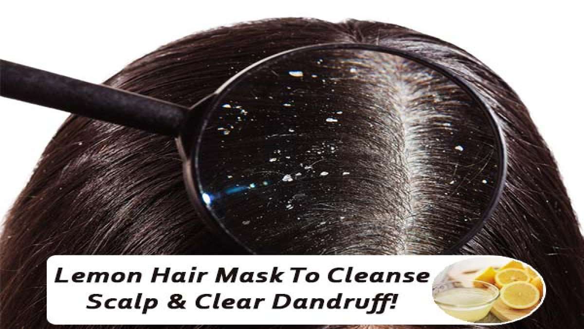 చుండ్రుని శాశ్వతంగా తొలగించే.. సింపుల్ అండ్ పర్ఫెక్ట్ రెమెడీ..!! Lemon Hair Mask To Cleanse