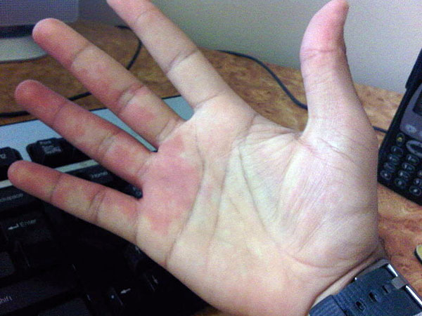 Facts Your Hands Tell About Your Health 010165