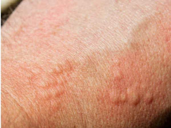 Important Facts About Skin Cancer 010165