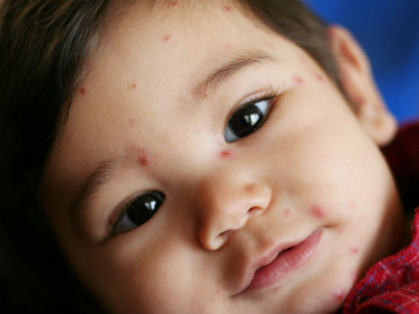 ఆటలమ్మ (chicken pox) :