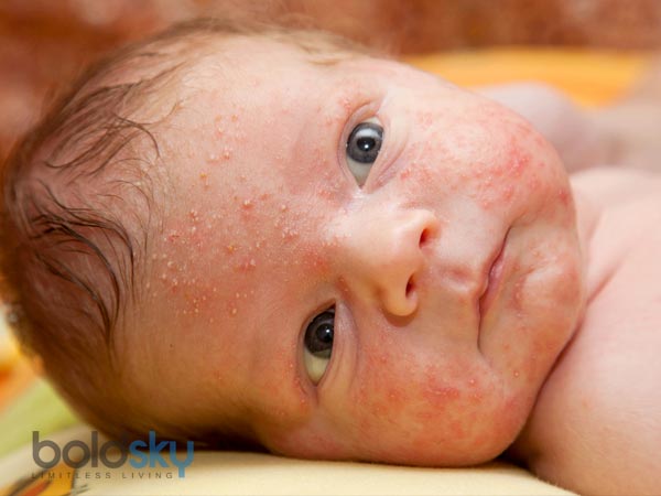 తామర (eczema) :