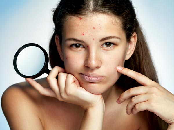 How To Use Apple Cider Vinegar To Treat Acne
