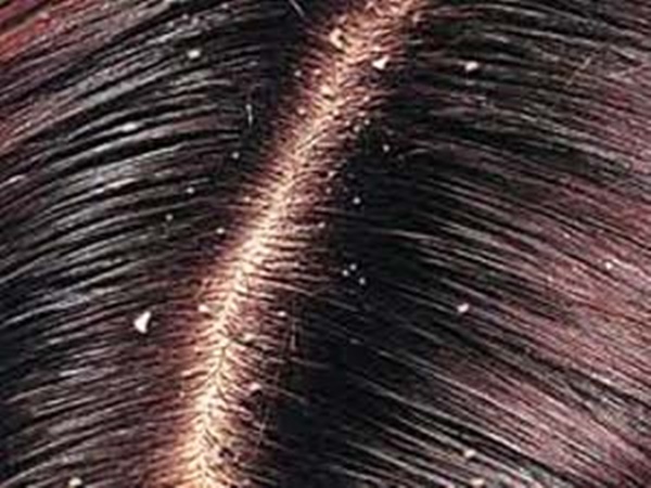 6. అల్లము + ఆపిల్ సైడర్ వెనిగర్ :-
