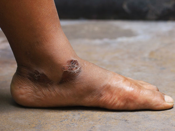 గాయాలు ఆలస్యంగా నయం అవుతాయి