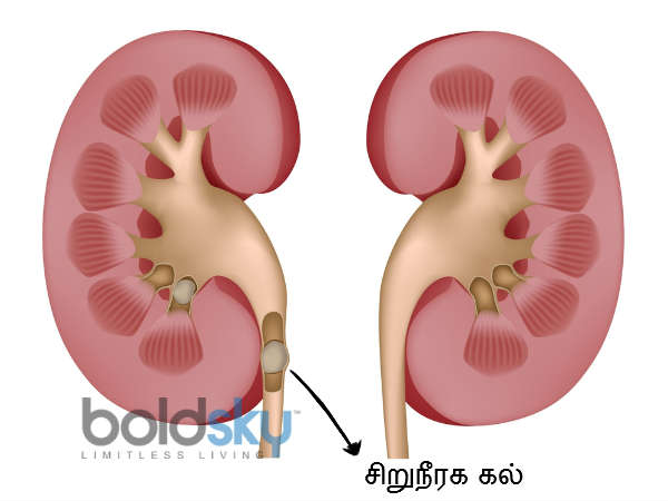 మూత్రపిండాల అవరోధం