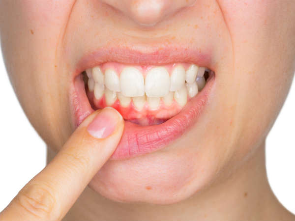 malocclusion(పైదంతములు క్రింది దంతములకు పొందిక లేకుండుట)