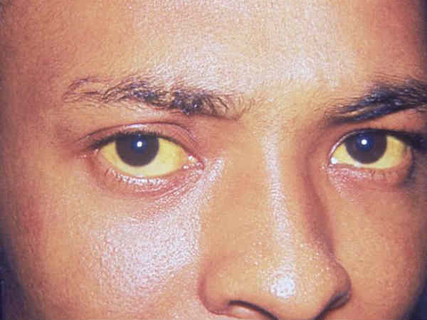 6. పసుపు కళ్ళు, తొక్కలు