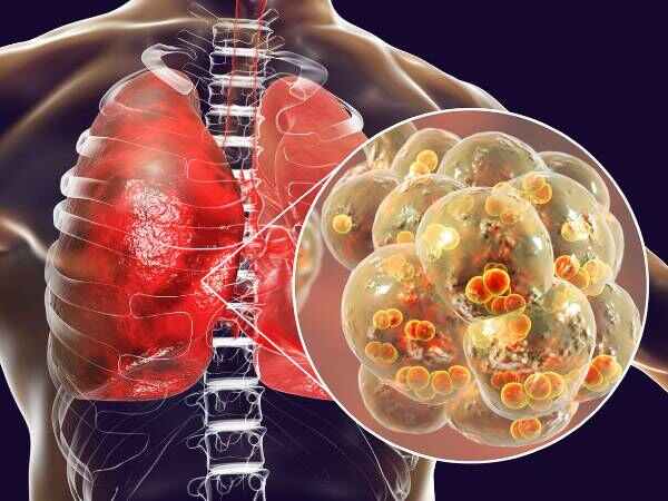 కోవిడ్ మరియు న్యుమోనియా మధ్య సంబంధం