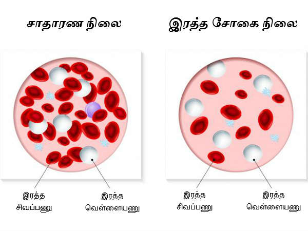 హైపర్కాల్సెమియా