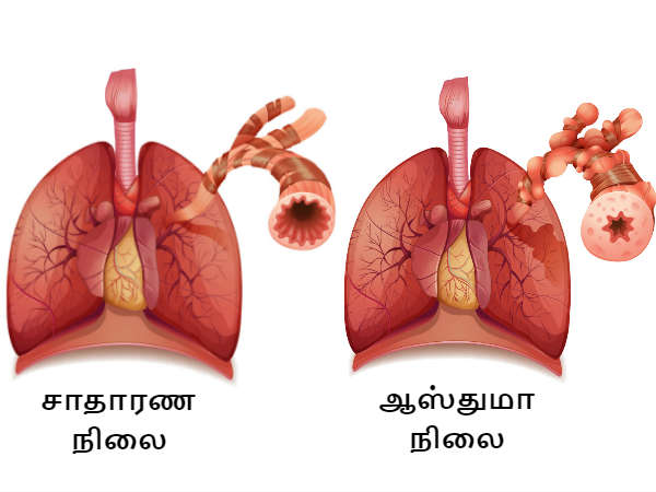 ఆస్తమా అంటే ఏమిటి?