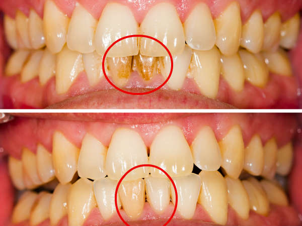 Benefits Of Mouthwash For Healthy Teeth And Gums In Telugu