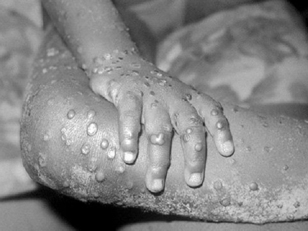 మంకీ పాక్స్ మరియు కోవిడ్ కారణంగా