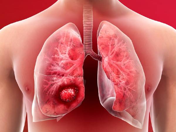 క్రానిక్ అబ్స్ట్రక్టివ్ పల్మనరీ డిసీజ్(COPD):