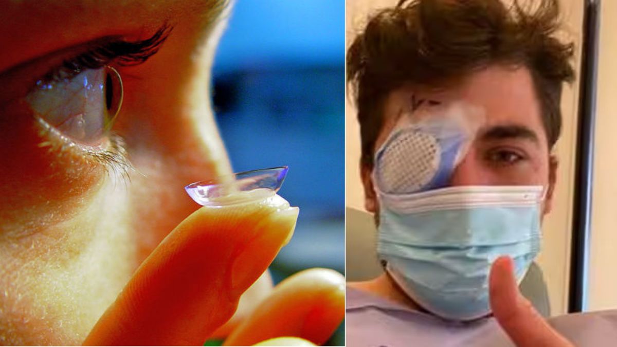 Parasite Eat Eye కాంటాక్ట్ లెన్స్‌తో నిద్రపోతే.. కంటినే తిన్న