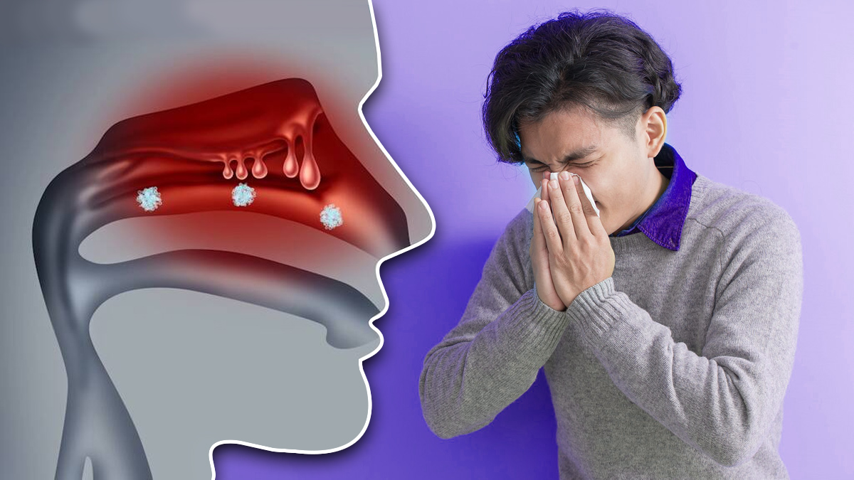 H1N1 Influenzaఅప్పర్ రెస్పిరేటరీ ఇన్ఫెక్షన్ ముక్క, గొంతు, శ్వాసకోశ