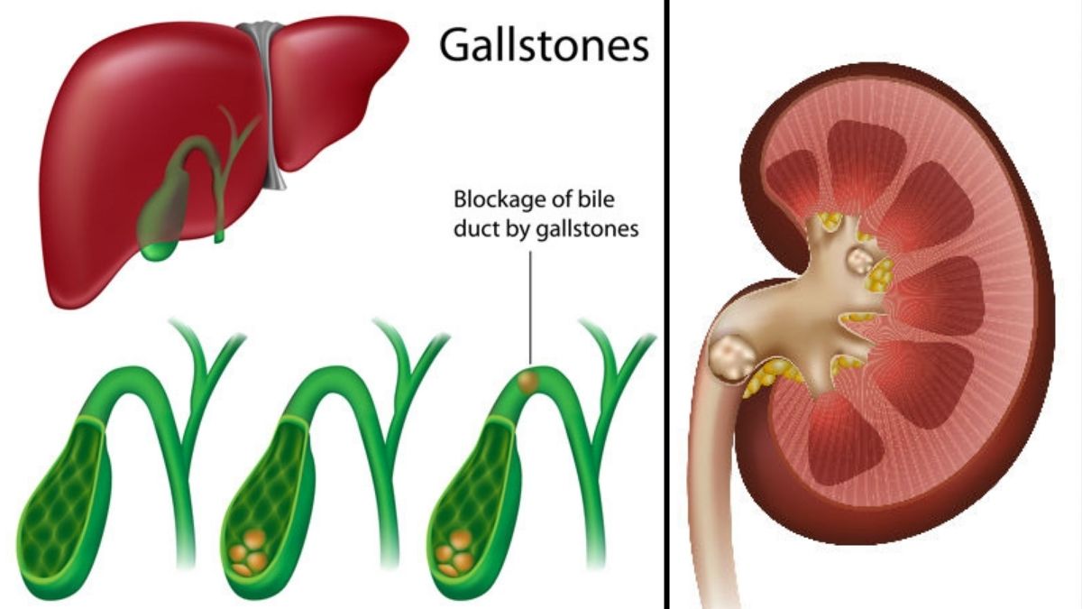 Kidney VS Gallbladder Stones కిడ్నీ స్టోన్స్, గాల్ బ్లాడర్ స్టోన్స్