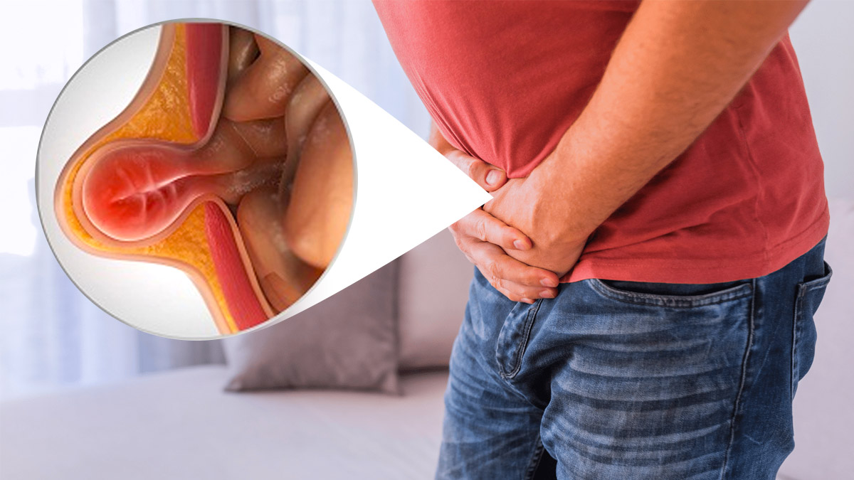 Why Men Are More Prone To Hernia Than Women Details In Telugu