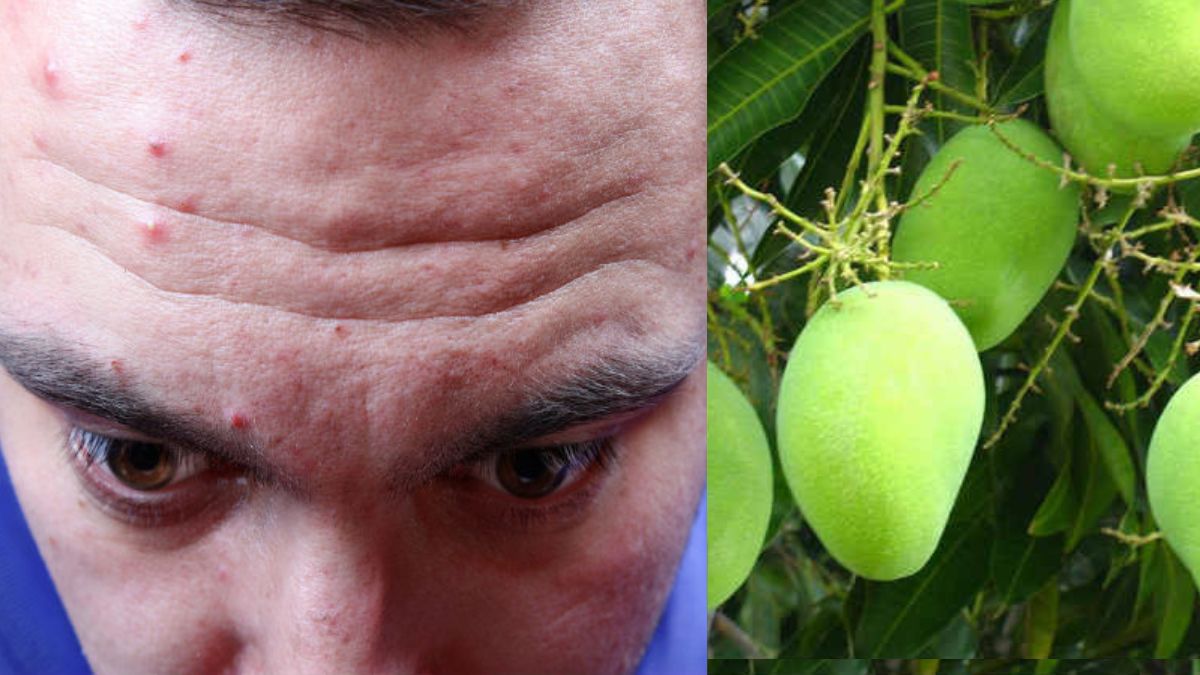 మామిడి పండ్లు తింటే ముఖంపై మొటిమలు ఇబ్బంది పెడుతున్నాయా? Why You Get Pimples After Eating