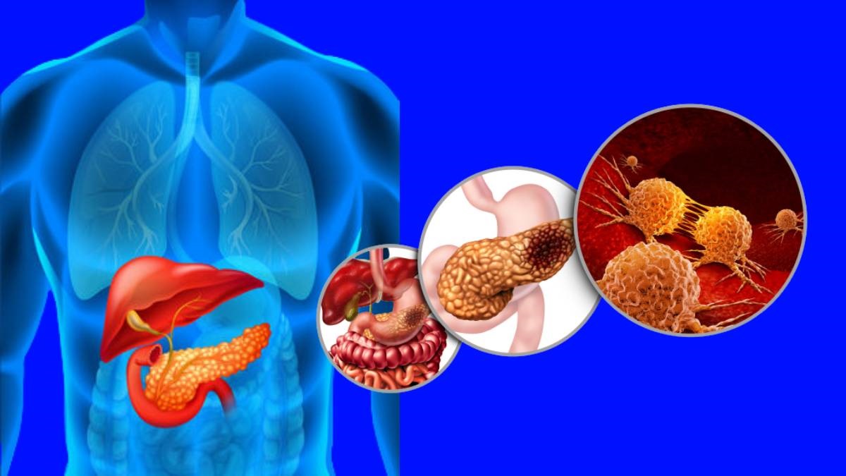 World Pancreatic Cancer Day 2023 Pancreatic Cancer Causes Symptoms And Treatment In Telugu